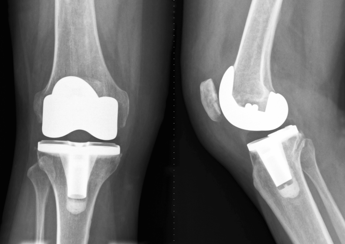 Knee Replacement