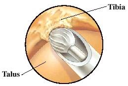 ankle arthroscopy conditions treated bone spurs