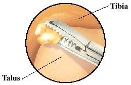 ankle arthroscopy conditions treated loose bodies