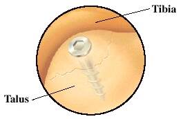 ankle arthroscopy conditions treated ocd