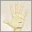 carpal tunnel release surgery endoscopy