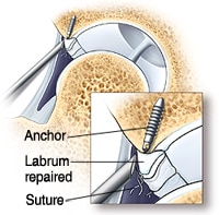 hip arthroscopy repairing labral tears fixed