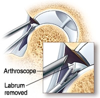 hip arthroscopy repairing labral tears non normal 01