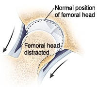 hip arthroscopy repairing labral tears normal