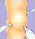 knee arthroscopy injections