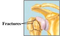 shoulder problems fracture