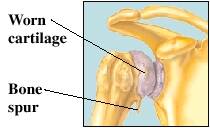 shoulder problems osteoarthritis