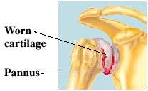 shoulder problems rheumatoid