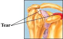 shoulder problems rotator tear