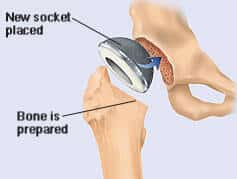 total hip replacement procedure