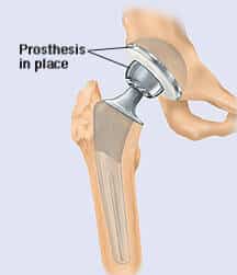 total hip replacement prosthesis