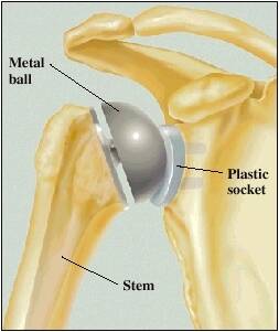 total shoulder replacement surgery ball socket