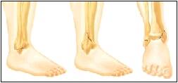 treating ankle fractures closed reduction