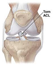 treating anterior cruciate ligament acl injuries torn acl