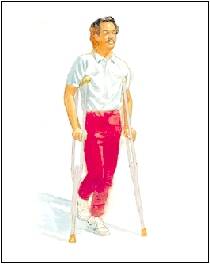 treating charcot foot crutches