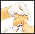 treating pressure ulcers of the foot cleaning