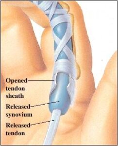 treating trigger finger surgery 243x300