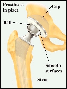 understanding hip replacement prosthesis