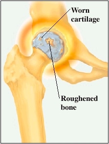understanding hip replacement worn