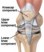 understanding knee replacement prosthesis