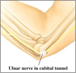 what is cubital tunnel syndrome tunnel