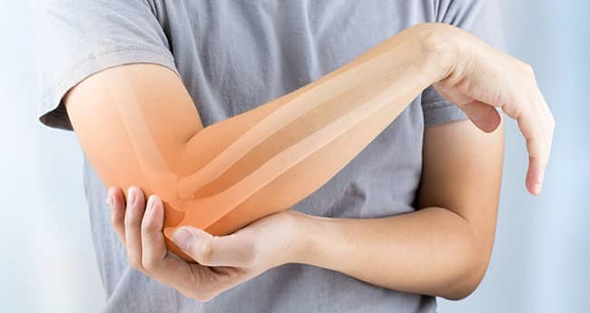 what is cubital tunnel syndrome