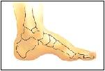 what is plantar fasciitis flat too little