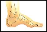 what is plantar fasciitis flat too little
