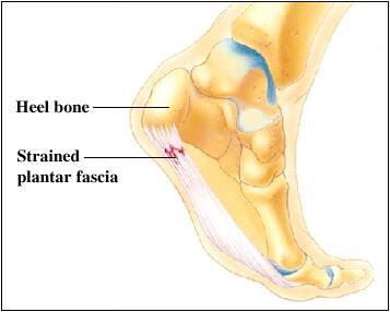 what is plantar fasciitis strained