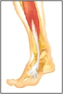 what is tendonitis of the foot left