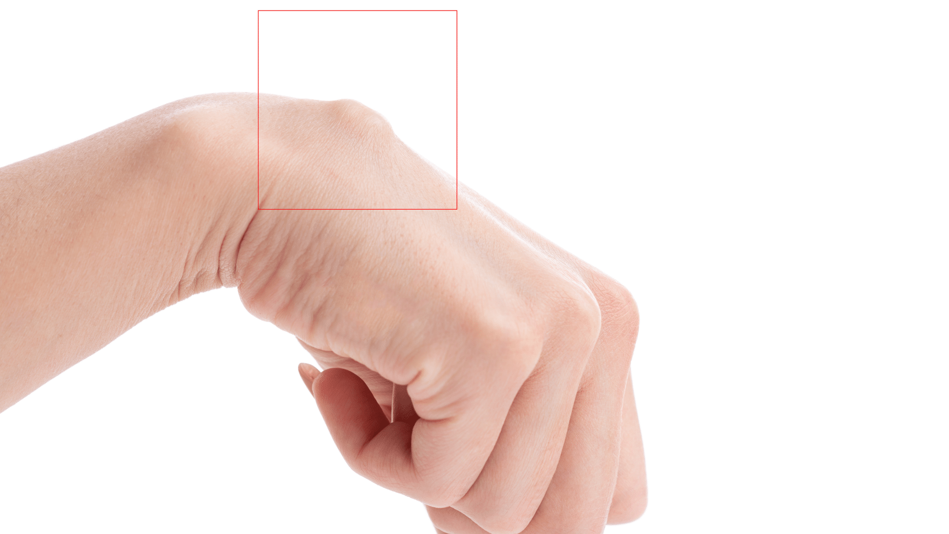 Wrist Ganglion Cyst